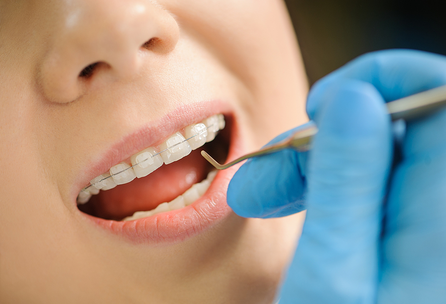 Ceramic Braces for Kids: A Clear Path to a Beautiful Smile