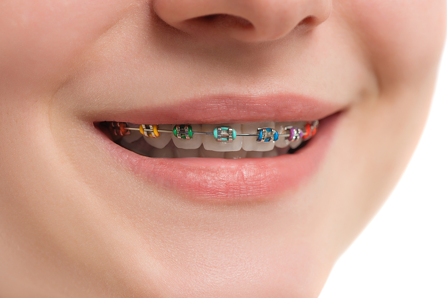 Life with Braces for Kids: A Guide to a Comfortable and Confident Smile